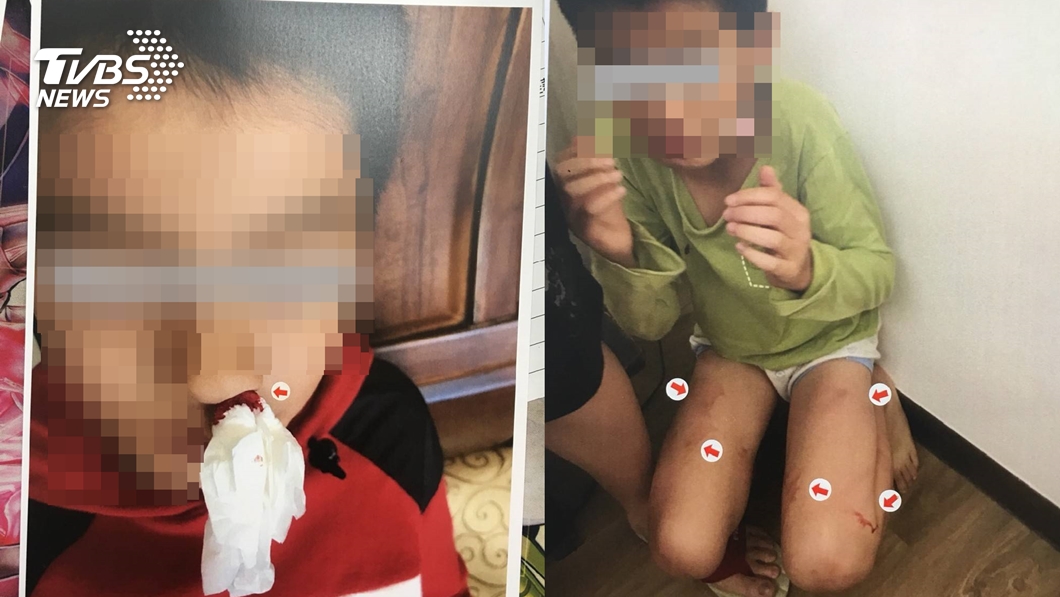 繼母虐童反咬「爸爸打的」 兒打臉:媽天天打好痛苦
