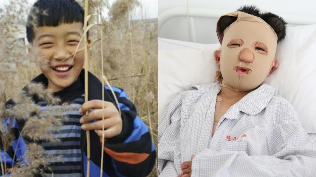 「火吻男孩」靠插管呼吸 不怕痛只問母:會不會拋棄我?