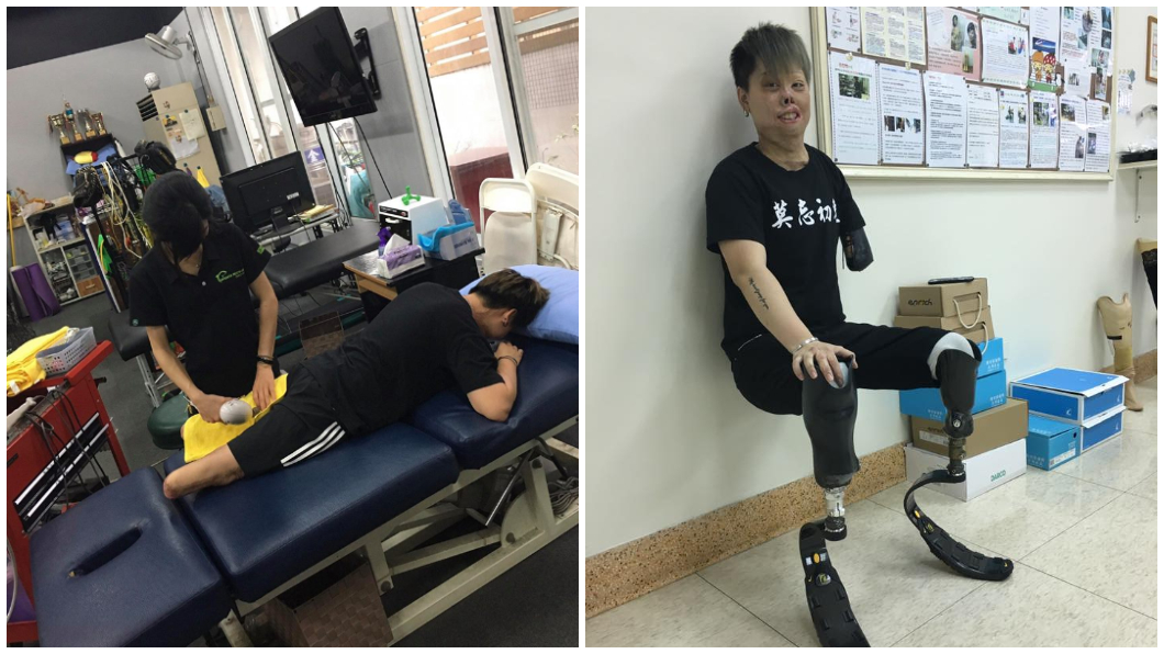 大火燒毀容貌…鋼鐵女孩僅剩右手:盼成為別人的祝福