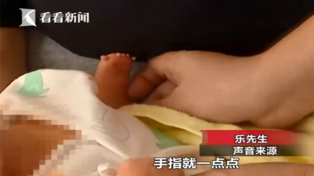 2醫保證「產檢沒問題」 嬰兒ㄧ出生沒手掌逼瘋爸媽