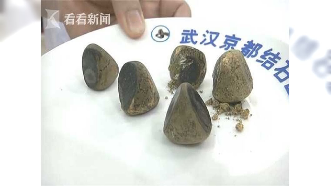 腹劇痛!膽囊拿出5顆「板栗」結石 醫:這習慣快改