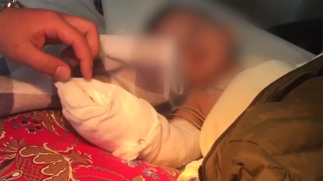 悚！外公切排骨　1歲孫女滑倒遭剁斷手掌