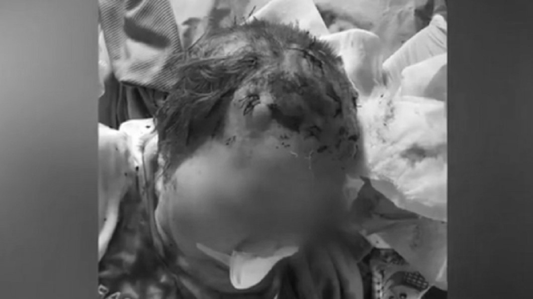 半夜頻尿爆衝突!8旬嬤遭保姆痛打 左眼失明血染床
