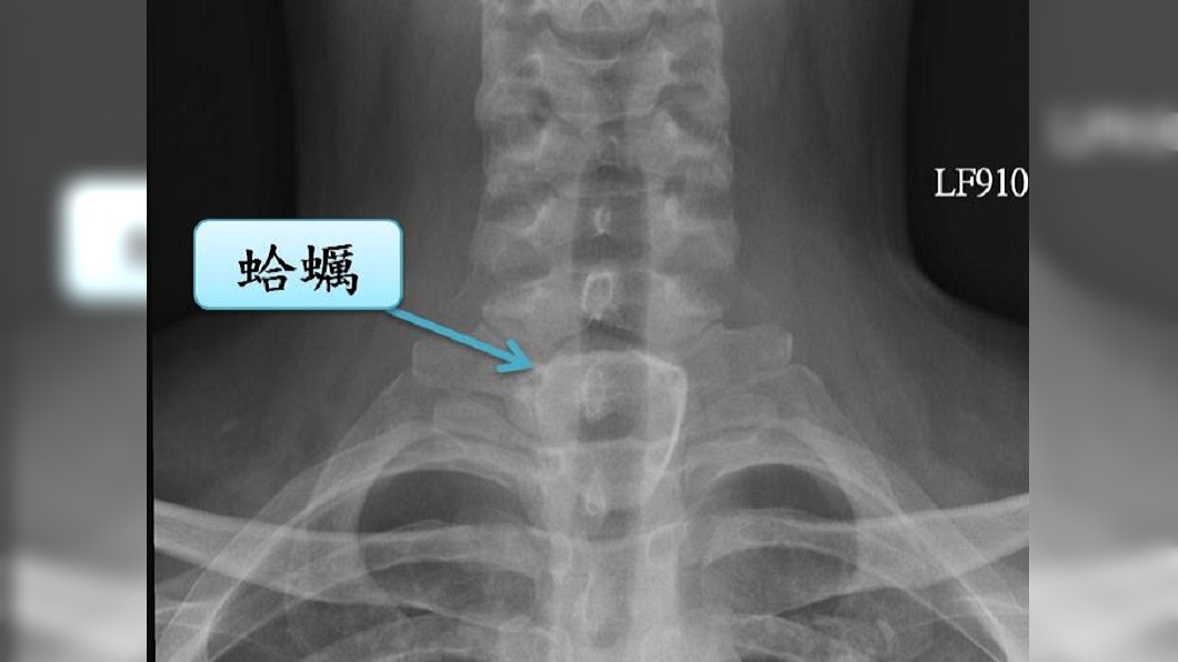 趕上班誤吞4公分大蛤蠣 男割破食道險喪命