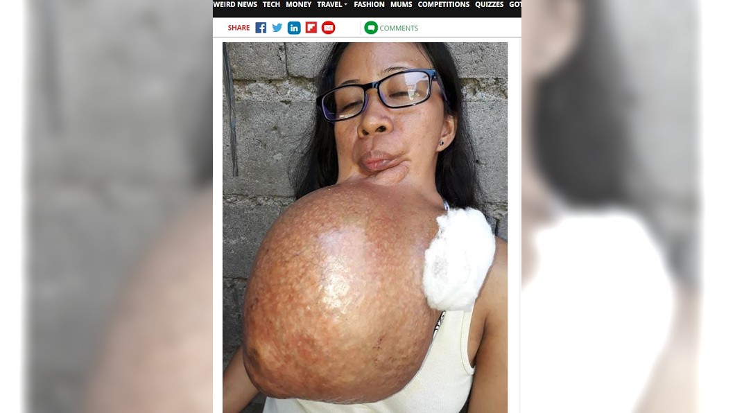 下顎痛誤以為牙痛! 婦下巴長詭異巨瘤「比西瓜大」