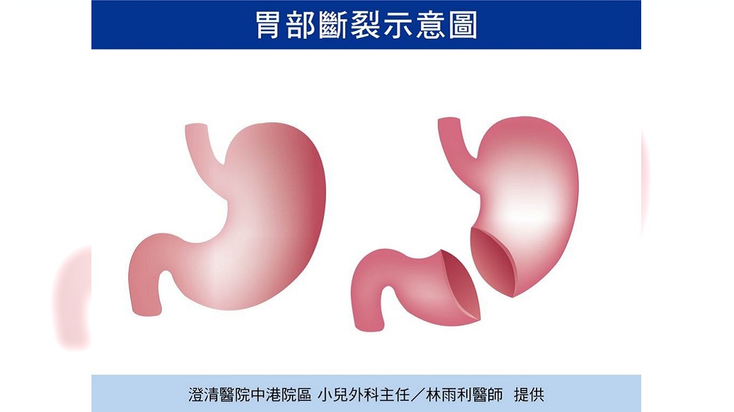男童車禍沒外傷　檢查才知...胃遭安全帶勒斷