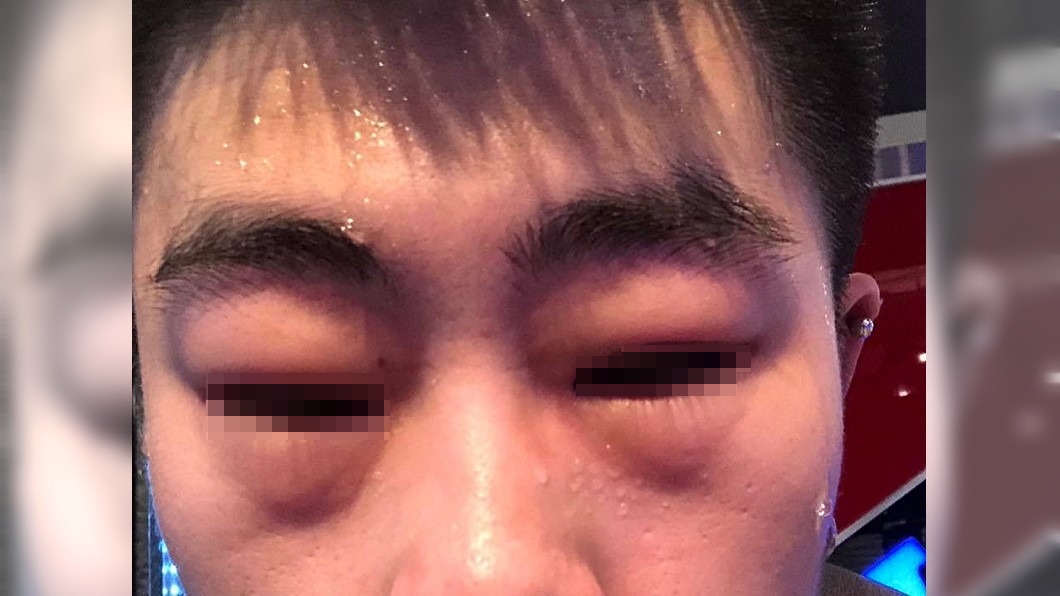 健身房毛巾擦汗!他臉腫呼吸困難 前員工:真的別用