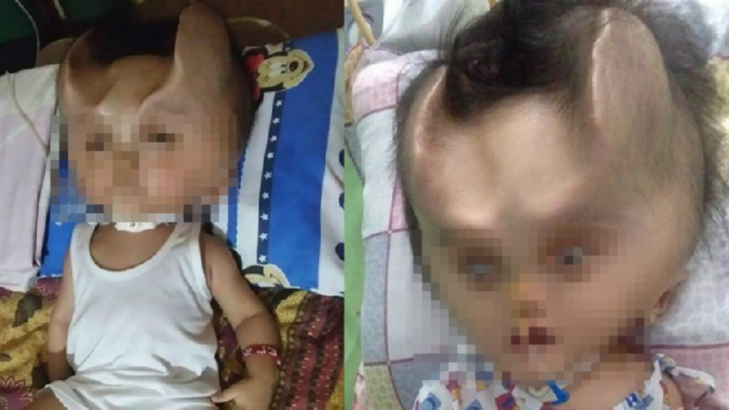 菲國男嬰罹罕病 術後頭部竟長出「惡魔之角」!