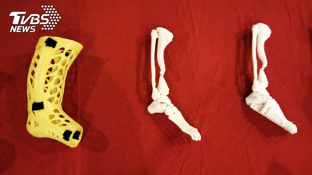 三總團隊結合3D技術，列印出阿莫的1：1骨頭模型（右、中）；左為可拆卸式石膏，可隨時查看骨頭癒合情形。(圖／TVBS)
