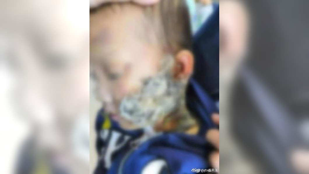 3歲男童被熱水燙傷 家人信偏方「貓毛敷臉」
