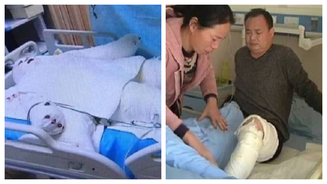 少女遇氣爆8成燒傷　父割皮20次：全身皮給她都行
