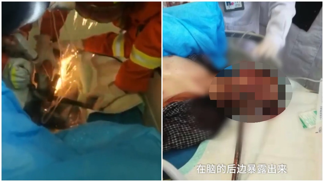 2公分粗鋼筋噴飛!從「鼻孔貫穿頭顱」工人躺血泊險死