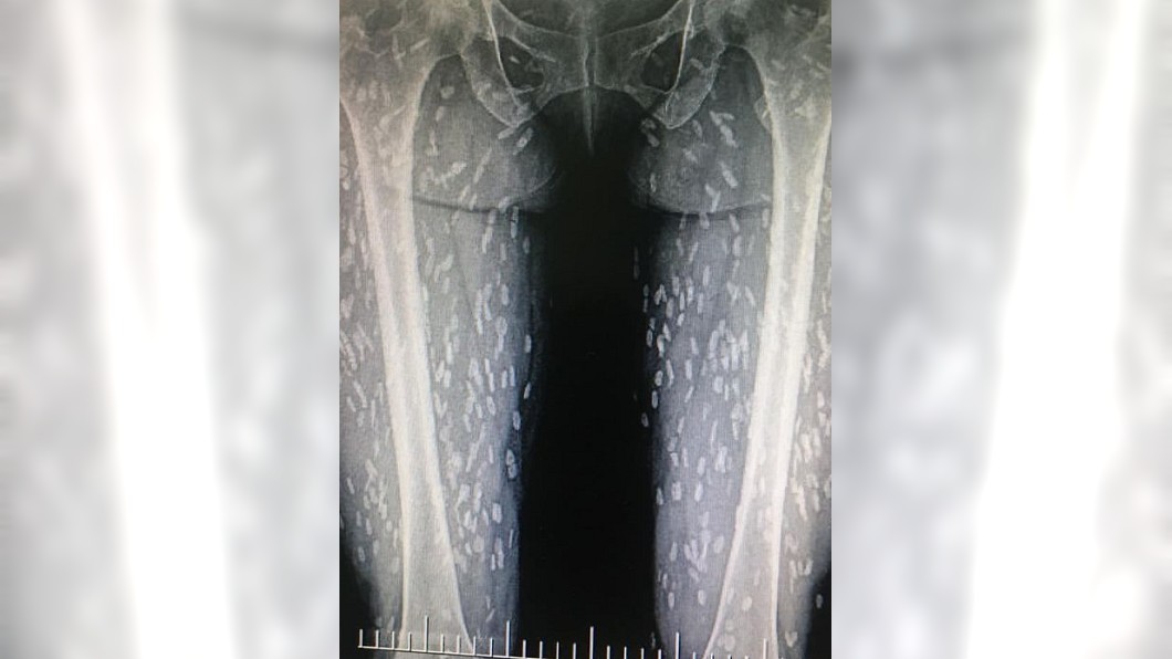 生食豬肉感染寄生蟲 女體內「上百隻鑽竄」X光照曝光