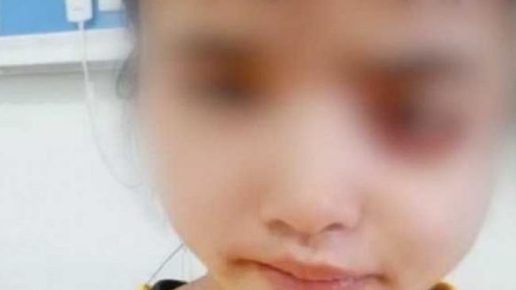 兩光醫亂拔牙!少女臉遭菌侵蝕 「眼球掉出」掛在外