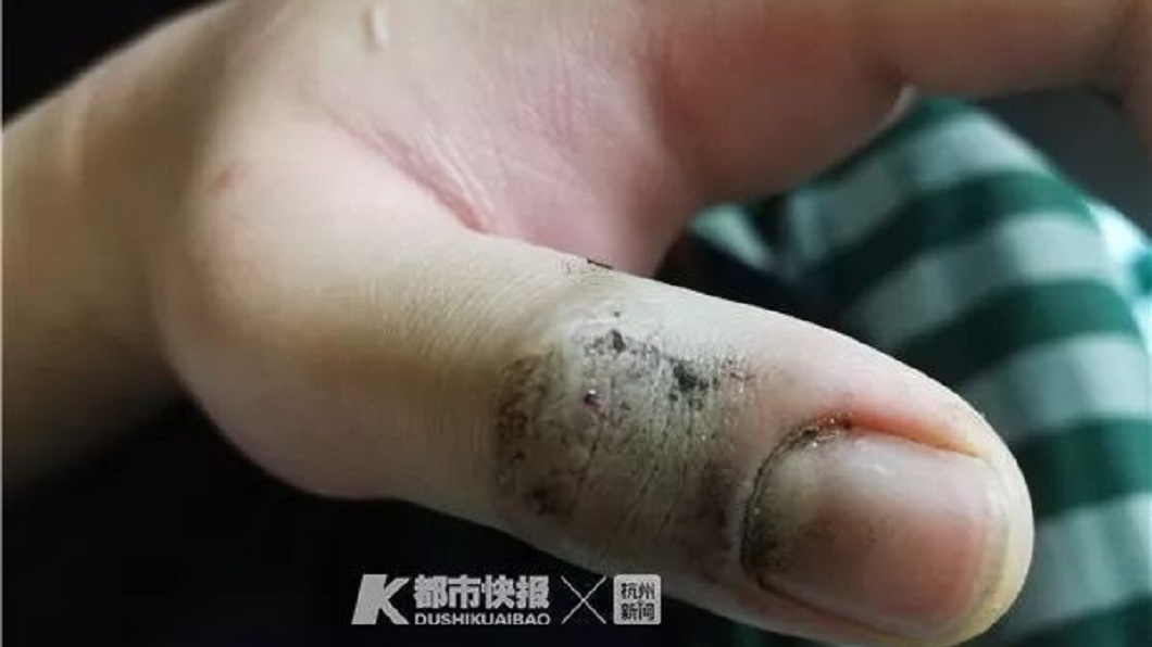 少年的大拇指被咬了一口,所幸緊急送醫急救保住一命。(圖/翻攝自微博)