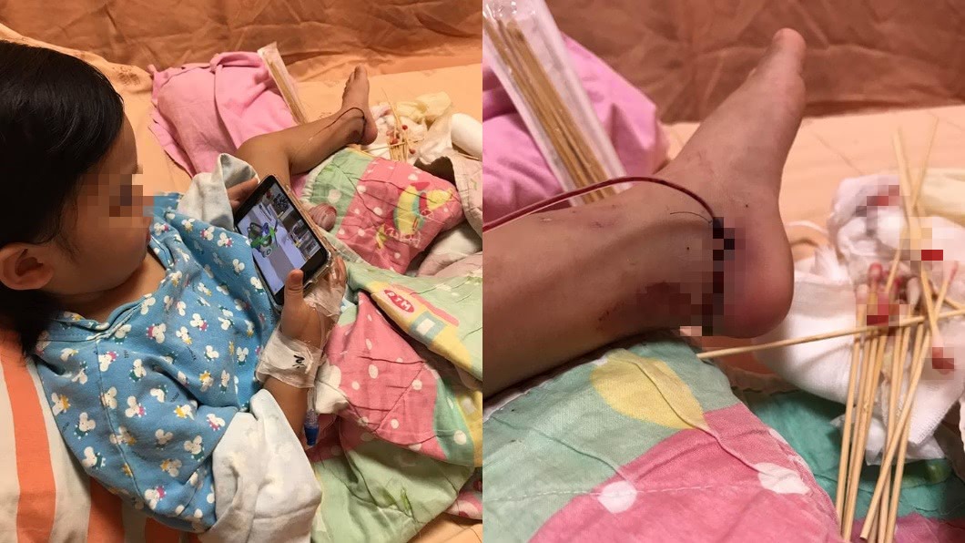 「腳踝肉炸開…」2歲女兒腳捲入車輪 媽心痛發文籲