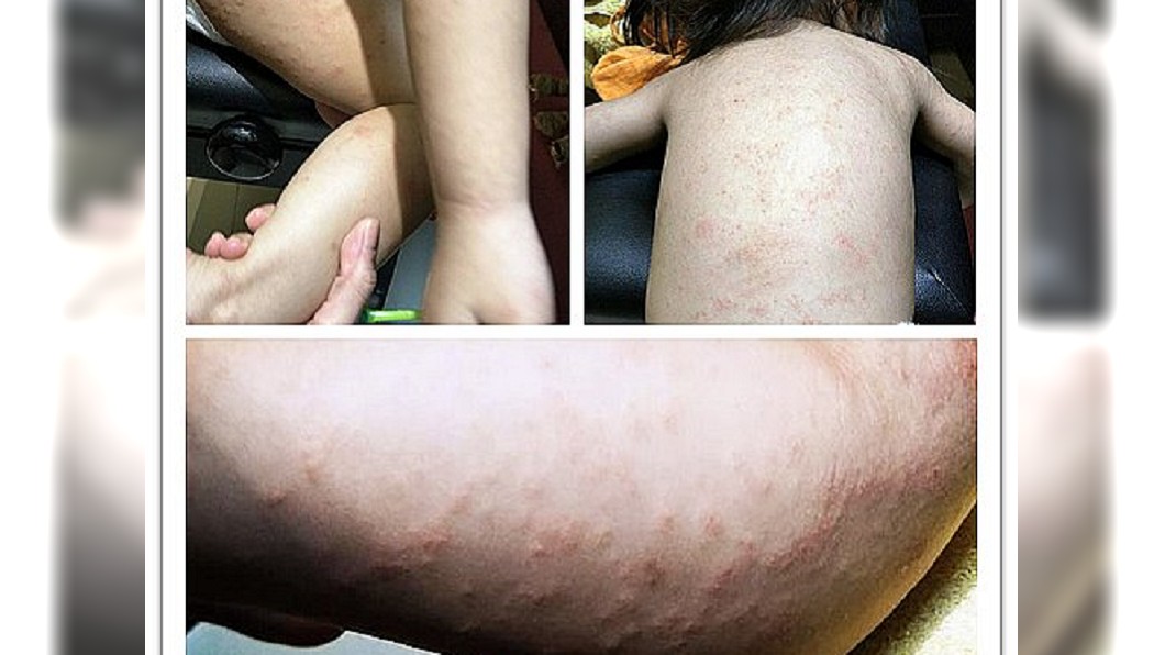 女兒全身紅疹!醫找不出病因 母一查「犯人」竟在門前