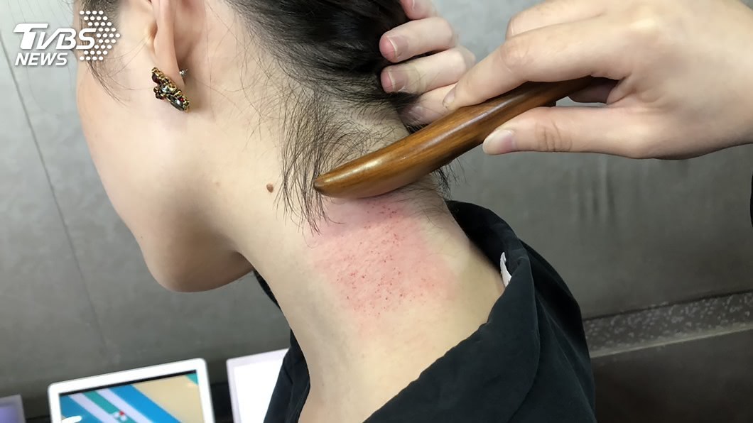 喜歡霧眉、刮痧? 醫師警告:當心感染C肝!