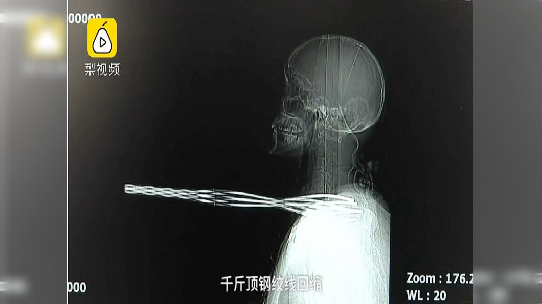 甲狀腺被打洞! 男工友慘遭7根鋼筋刺穿脖