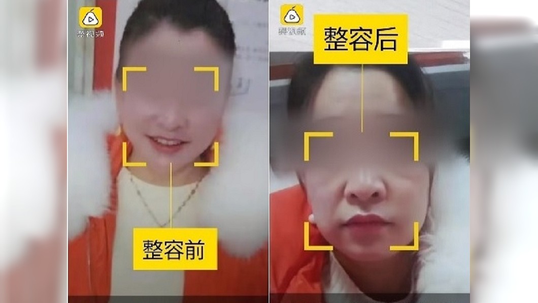 整形費砍12萬 醫生讓她變大媽!哭喊:我現在天天想死