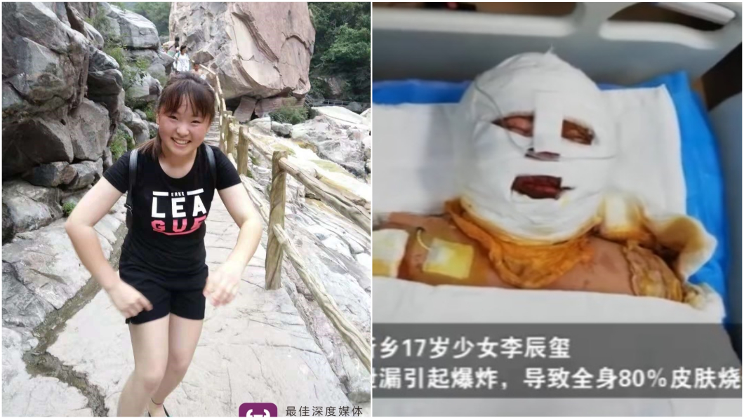 為何沒來看我?17歲少女遭火吻 父不現身真相惹淚崩