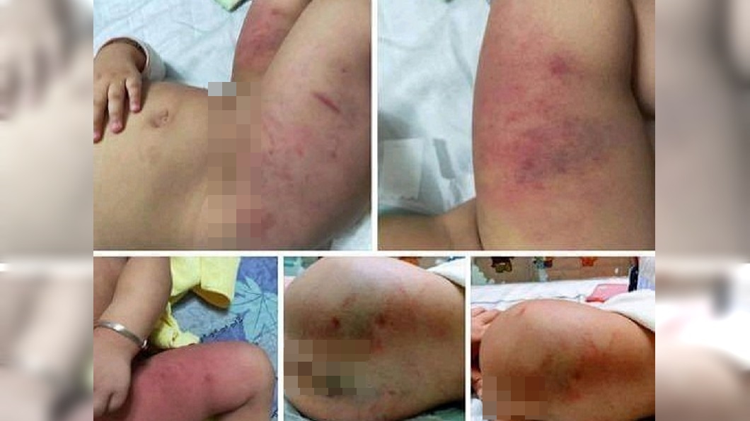 1歲女童洗澡嬉鬧遭毆打滿身瘀血 父:深感抱歉