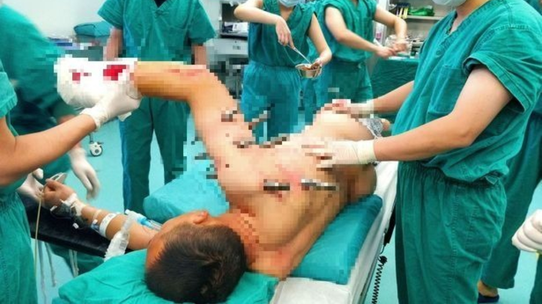 悚!工人被10根大鋼釘刺穿 慘變「人肉鋼板」噴血