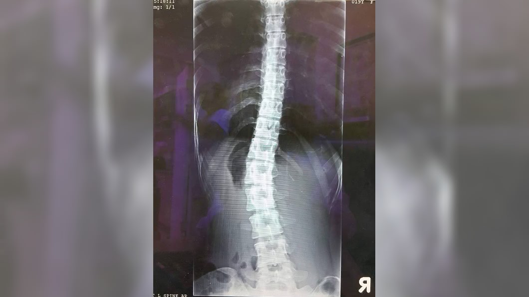 妙齡女背痛難耐 原是脊椎側彎惡化