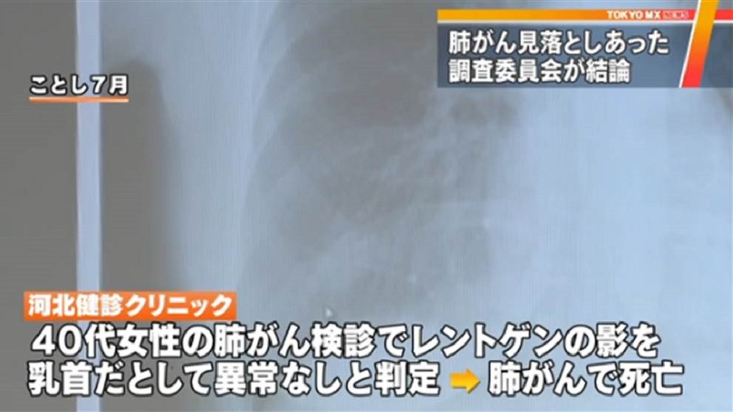 醫生錯把陰影當乳頭 女罹肺癌被誤診3次冤死