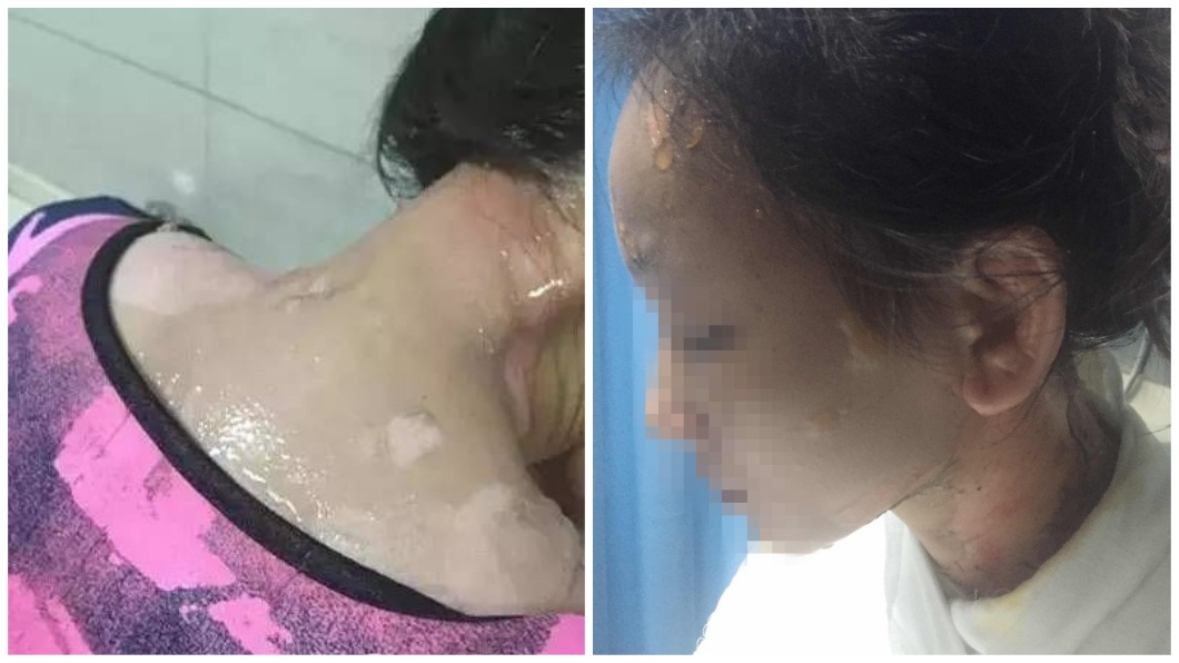 要求加湯起爭執 正妹遭服務生「熱水澆頭」毀容