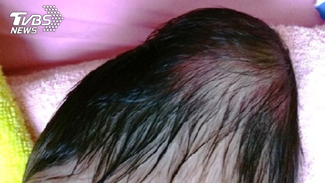 新生兒頭皮血腫別亂揉 8天大嬰「染菌」癱瘓