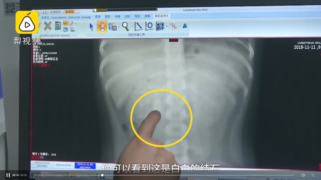 怕早產體虛家人狂進補 9歲童腎臟藏56結石