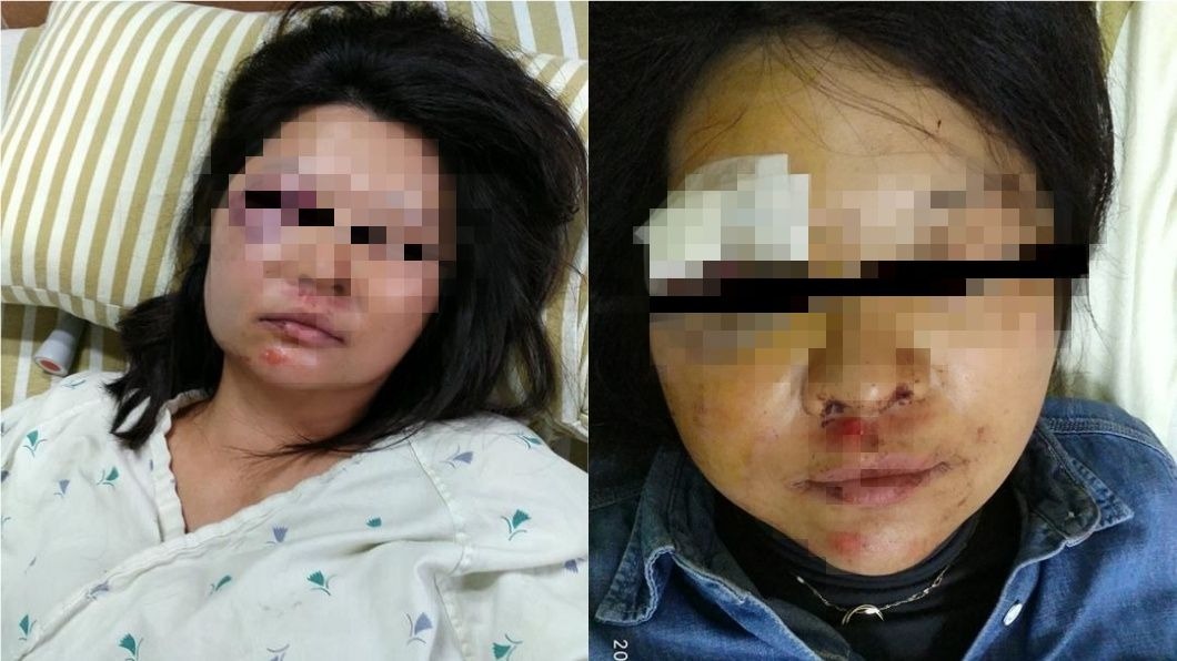 騎車被狗追 她摔成腦出血、臉毀容PO文勸世
