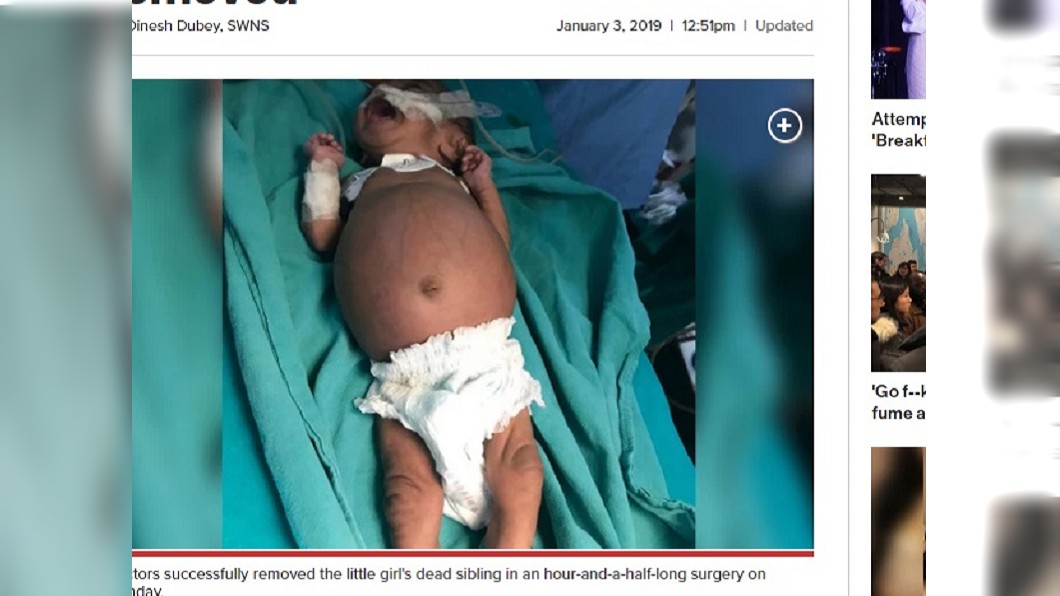 腹部腫如球!女嬰肚藏寄生胎 取出竟有「手和腳」