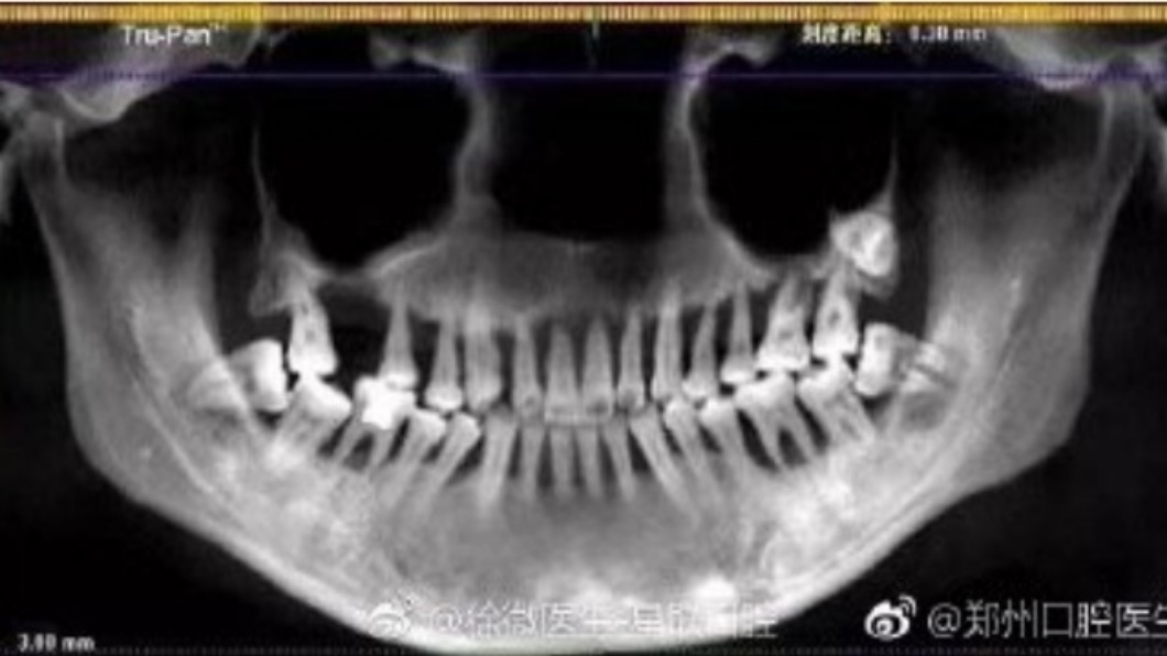 妙齡女吃消炎藥緩牙痛　「上排牙全掉光」如80歲無牙婆
