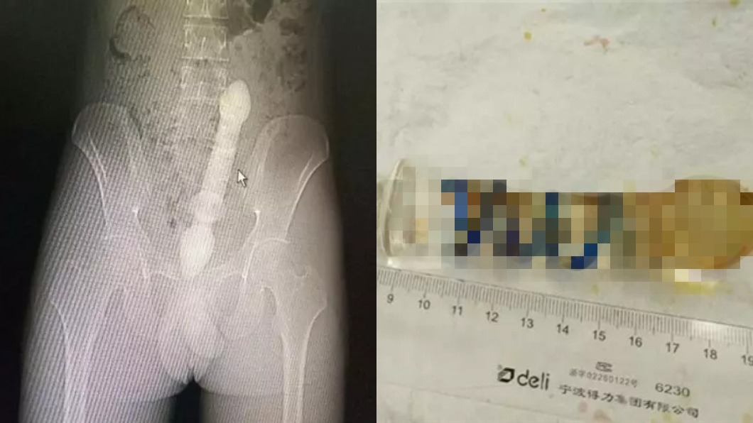 男拿25cm玻璃棒塞肛門　「卡住」急喊：醫生救我！