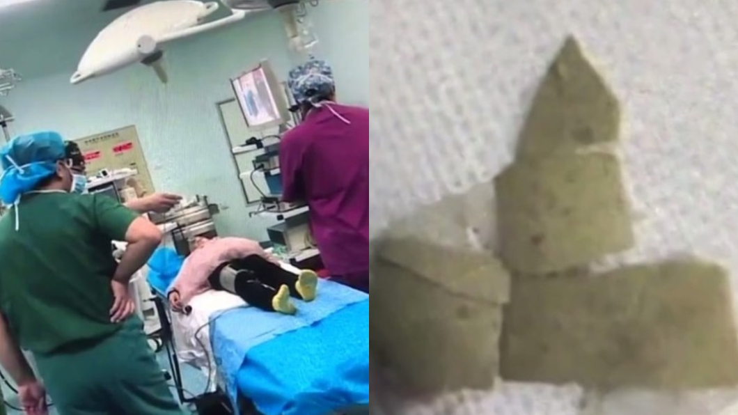 悚!吃麵誤吞蛋殼卡食道 險劃破6歲女童大動脈