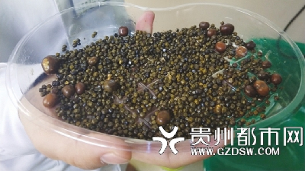 女長年不吃早餐…腹痛難耐就醫 取出2千顆結石切膽囊
