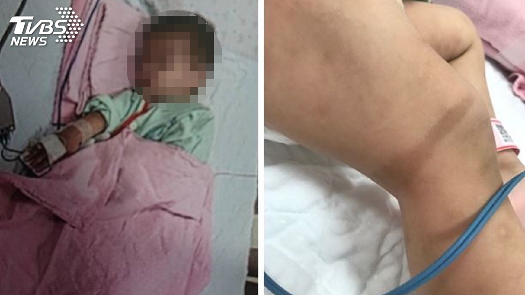 台南又傳虐童!1歲童腿疑遭綑綁 腦出血送加護病房