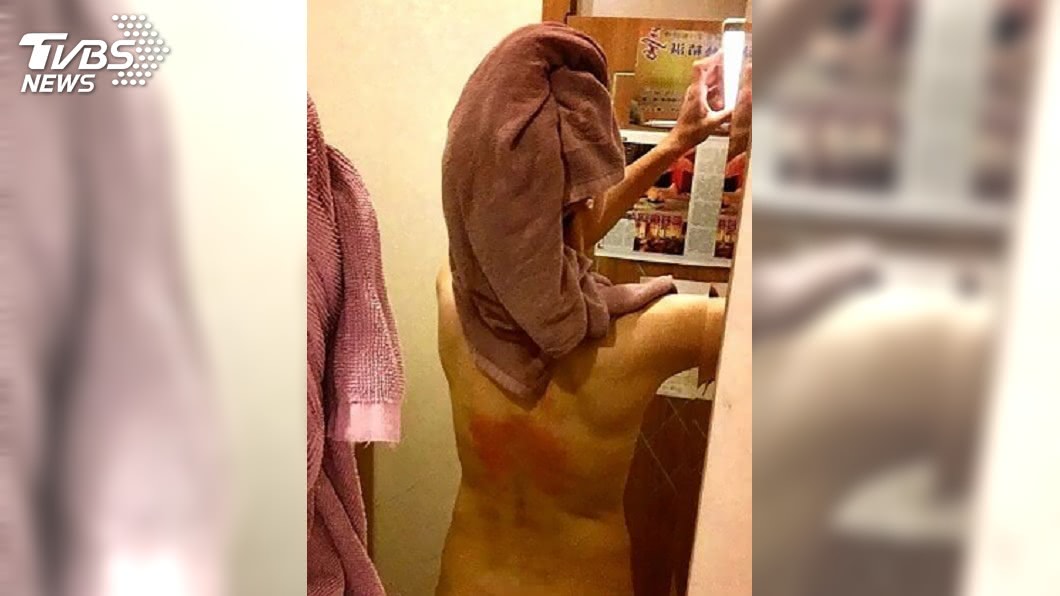 竹科女主管做岩盤浴紓壓 背臀燙傷私密處起水泡