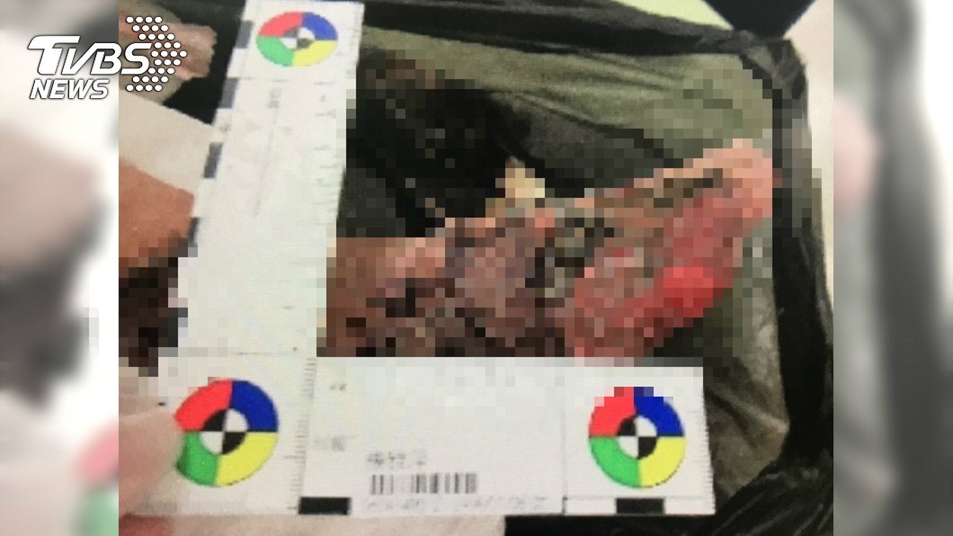 超噁!女大生車禍懶換藥 回診成「肥蛆窩」險截肢