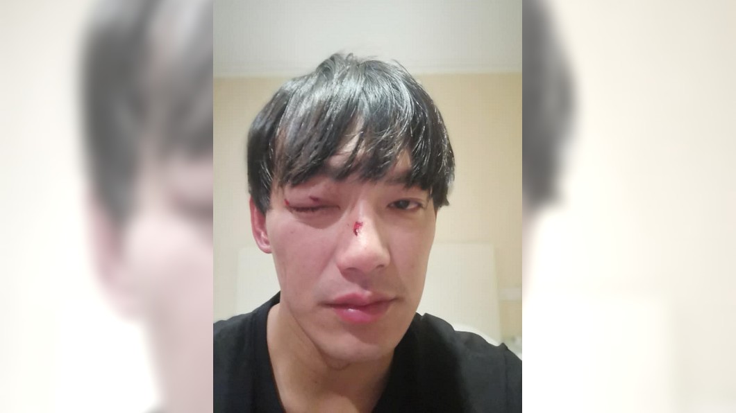 威廉大陸拍戲出意外 木劍傷眼視力剩0.3