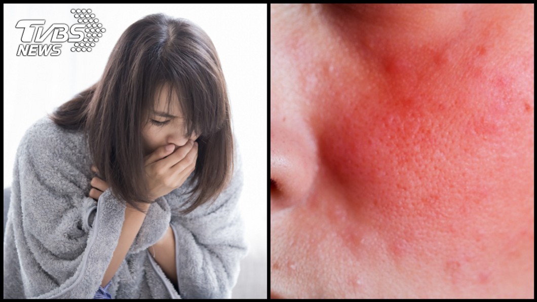 感冒引蜂窩性組織炎!她「鼻腔化膿」眼、臉全紅腫