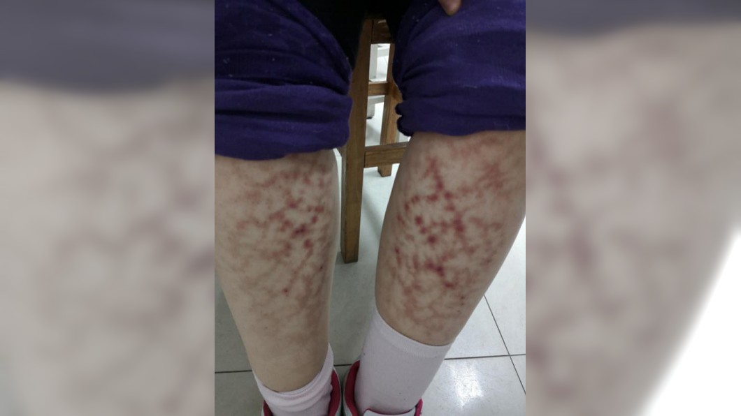 嚇人!愛窩電暖爐旁 她小腿長滿「網狀紅斑」