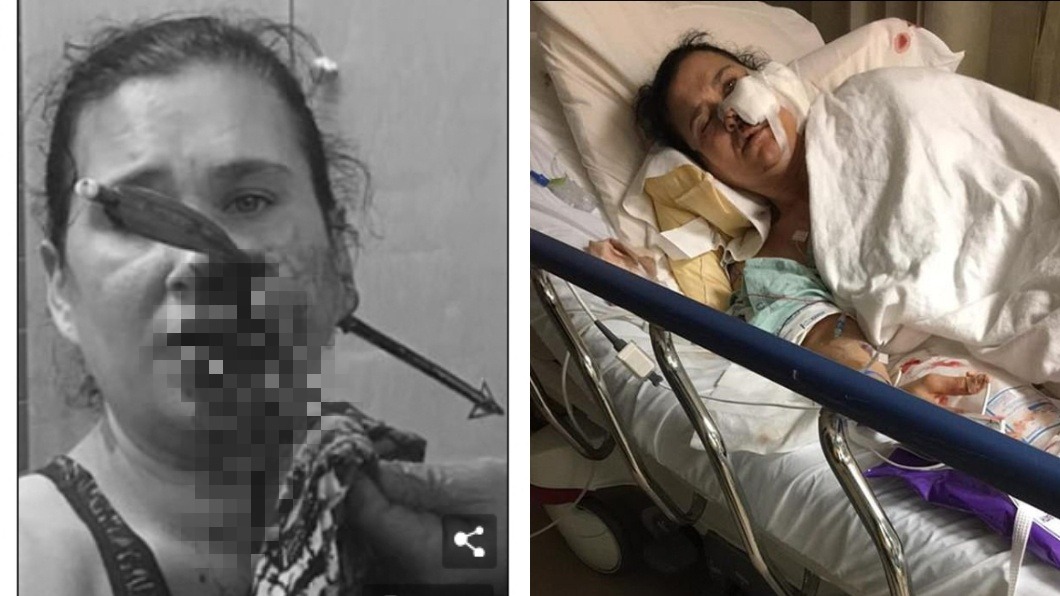 勇媽救子！慘遭十字弓「射穿臉」爆血　半張臉近毀容