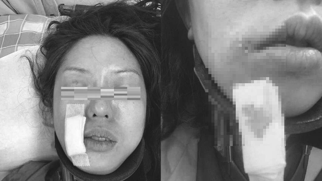 成大操場滑手機 慢跑女遭痛毆「嘴角撕裂縫5針」