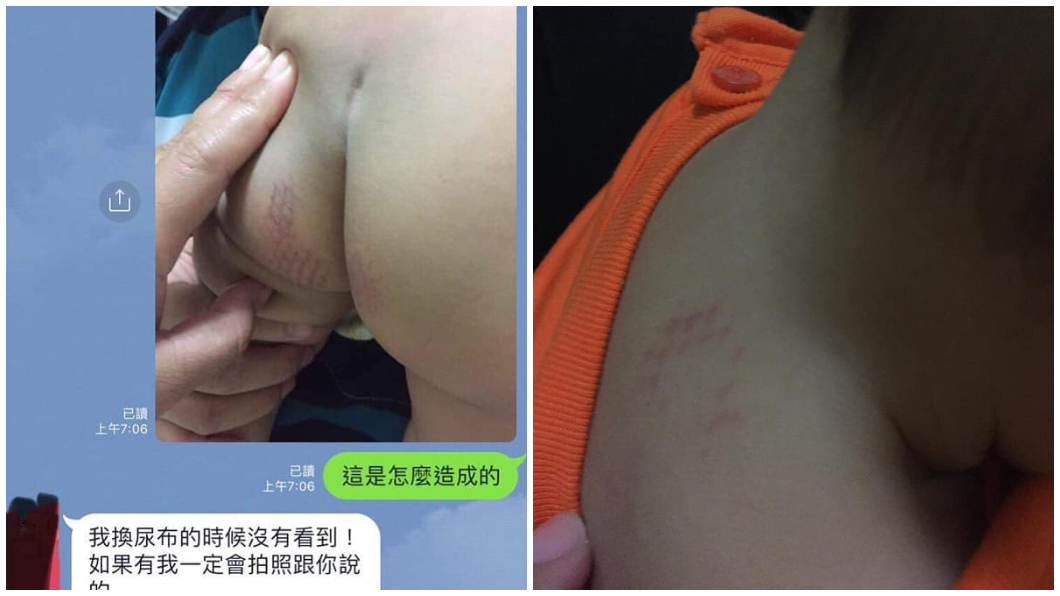 1歲兒生殖器燙出「網狀烙印」!父控保母吹風機施虐