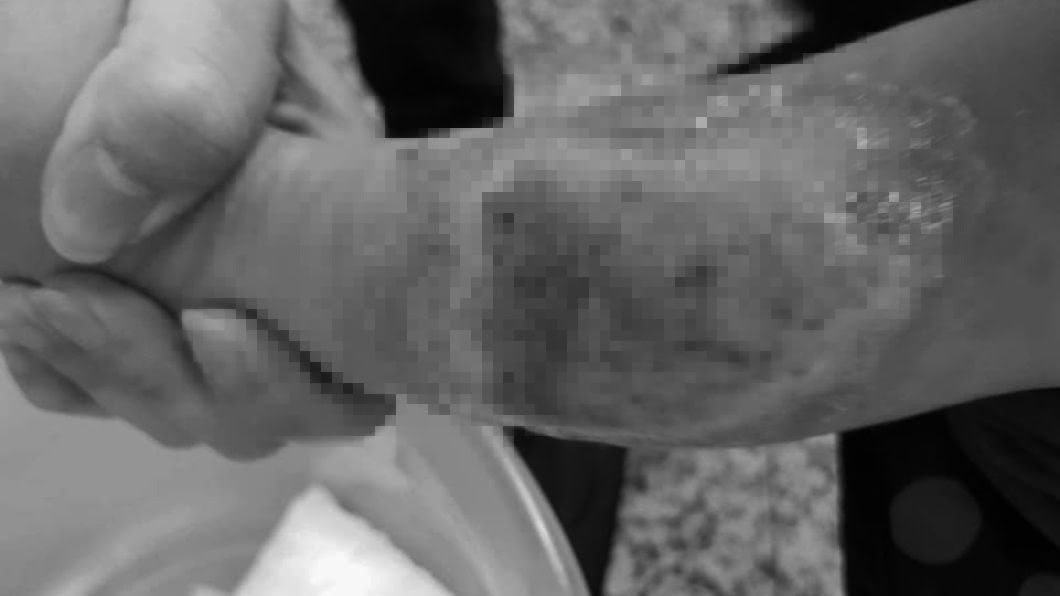 嬰疑遭保母燙傷!腿噴血潰瘍 母心碎控:良心過得去?