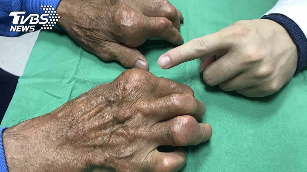 猛嗑火鍋、海鮮!男關節長「雞蛋石」 如千根針狂刺