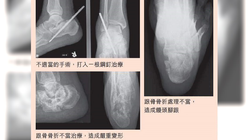 ▲不適當的跟骨骨折治療:打鋼釘治療沒用,形成「饅頭腳跟」(圖/《自己的腳痛自己救》;時報出版提供)